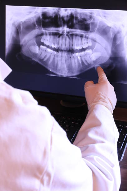 Best Emergency Wisdom Teeth Removal in Laurel Bay, SC